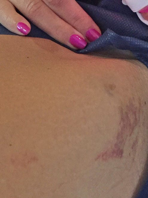 A photo of bruises Heidi Sorrem received on her inner thigh area, which she doesn't know how they got there.