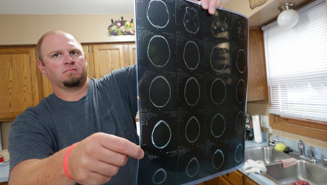Corey Sorrem holds up the X-rays of his wife, Heidi Sorrem's skull after an injury she received on vacation at a Mexico resort. After a fall, Heidi received several stitches to her head and a concussion.