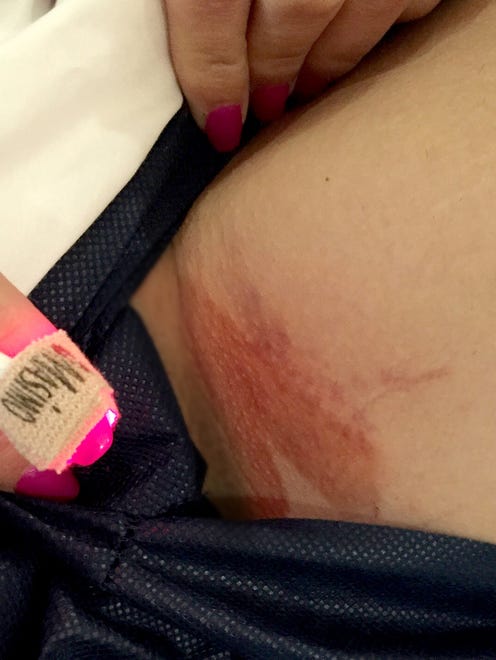 A photo of bruises Heidi Sorrem received on her inner thigh area, which she doesn't know how they got there.